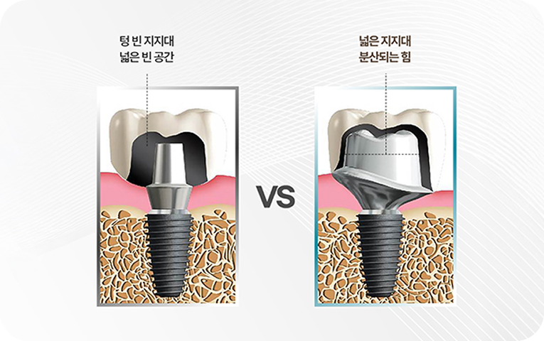 일반과 맞춤형 지대주의 차이